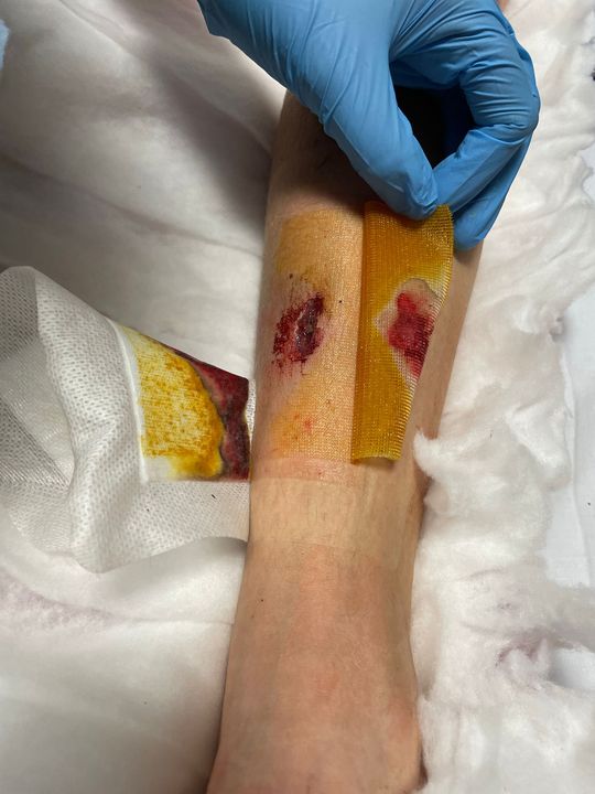 Photographs show the extent of the boy’s injuries following the dispute at the disused hotel